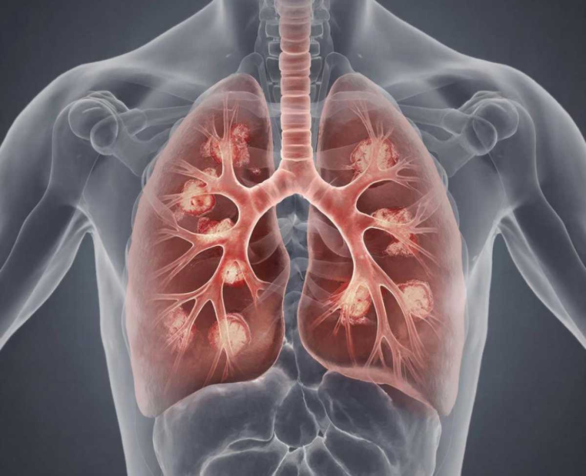 Как защититься от туберкулёза?