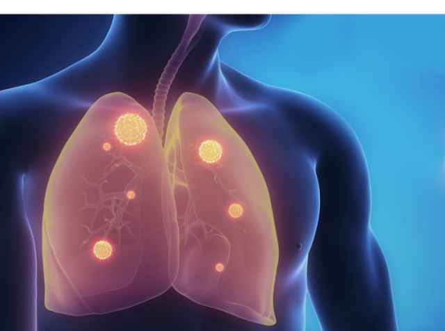 COVID‑19 особенно опасен для лёгких.
